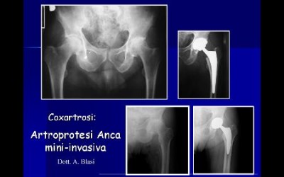 Chirurgia protesica d’anca mini-invasiva