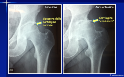 Artrosi dell’anca (Coxartrosi): cause e terapie